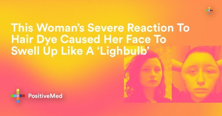 This Woman’s Severe Reaction To Hair Dye Caused Her Face To Swell Up Like A ‘Lighbulb’ This Woman’s Severe Reaction To Hair Dye Caused Her Face To Swell Up Like A ‘Lighbulb’
