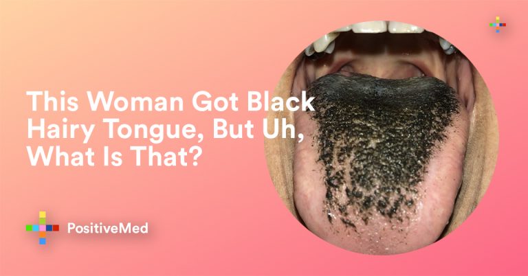 What to Do About Black Hairy Tongue. What is that? What to Do About Black Hairy Tongue. What is that?