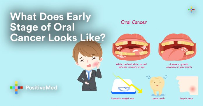 What Do Early Stages of Oral Cancer Look Like