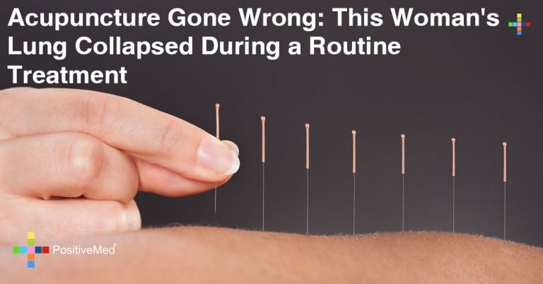 Acupuncture Complications: This Woman’s Lung Collapsed After Routine Treatment Acupuncture Complications: This Woman’s Lung Collapsed After Routine Treatment