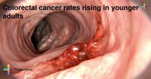 Colorectal-cancer-rates-rising-in-younger-adults