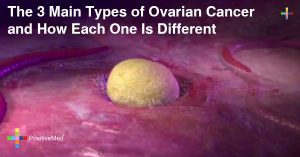 The 3 Main Types of Ovarian Cancer—and How Each One Is Different