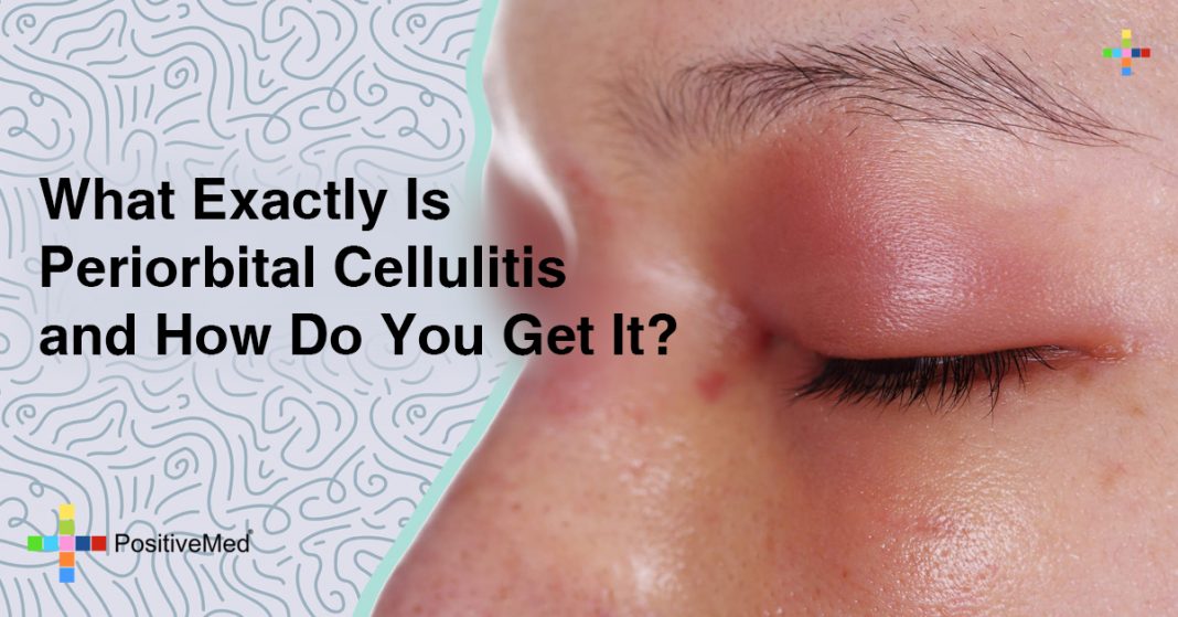 Does periorbital cellulitis itch maqsign