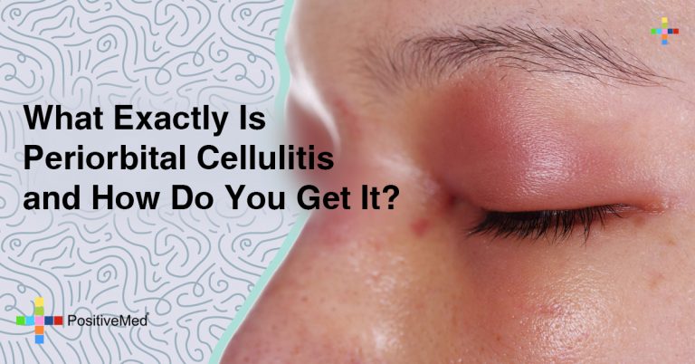 What Exactly Is Periorbital Cellulitis—and How Do You Get It?