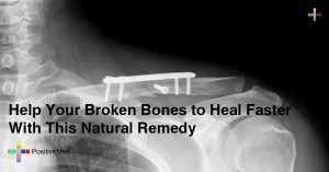 Help Your Broken Bones to Heal Faster With This Natural Remedy