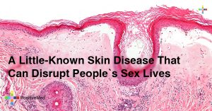 A-Little-Known-Skin-Disease-That-Can-Disrupt-People’s-Sex-Lives