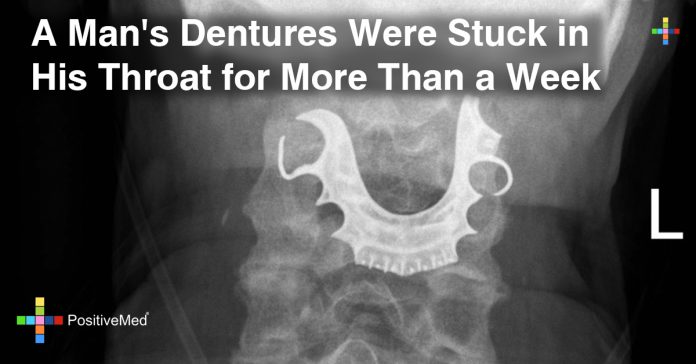 A Man's Dentures Were Stuck in His Throat for More Than a Week