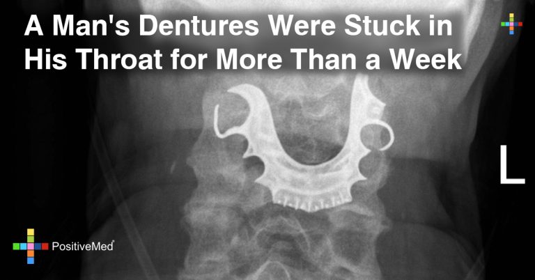 A Man’s Dentures Were Stuck in His Throat for More Than a Week