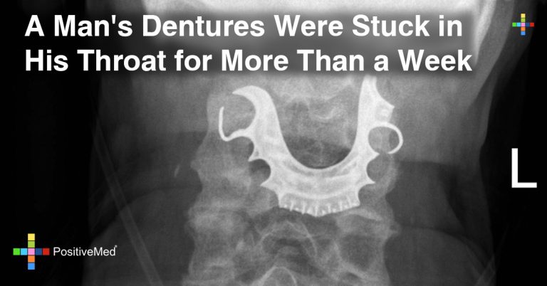 A Man’s Dentures Were Stuck in His Throat for More Than a Week A Man’s Dentures Were Stuck in His Throat for More Than a Week