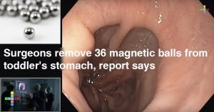 Surgeons-remove-36-magnetic-balls-from-toddlers-stomach-report-says
