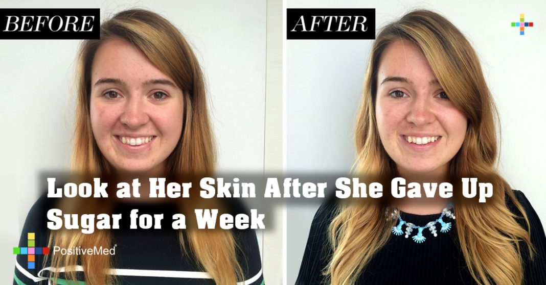 Look at Her Skin After She Gave Up Sugar for a Week PositiveMed