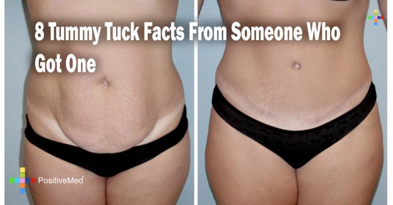 8 Tummy Tuck Facts From Someone Who Got One 8 Tummy Tuck Facts From Someone Who Got One
