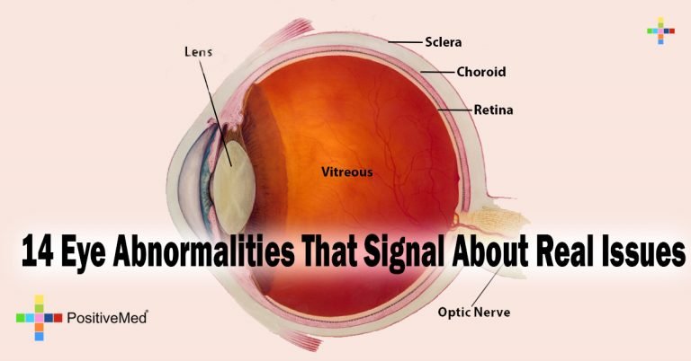14 Eye Abnormalities That Signal About Real Issues