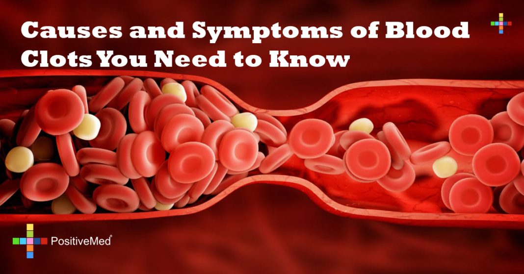 Causes And Symptoms Of Blood Clots You Need To Know Positivemed
