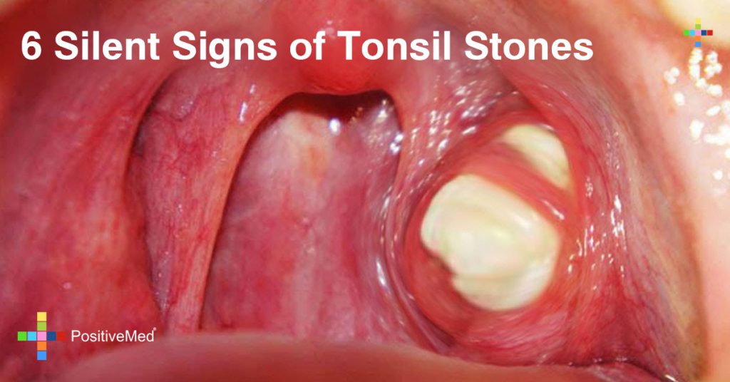 6 Silent Signs of Tonsil Stones You Need to Be Aware of