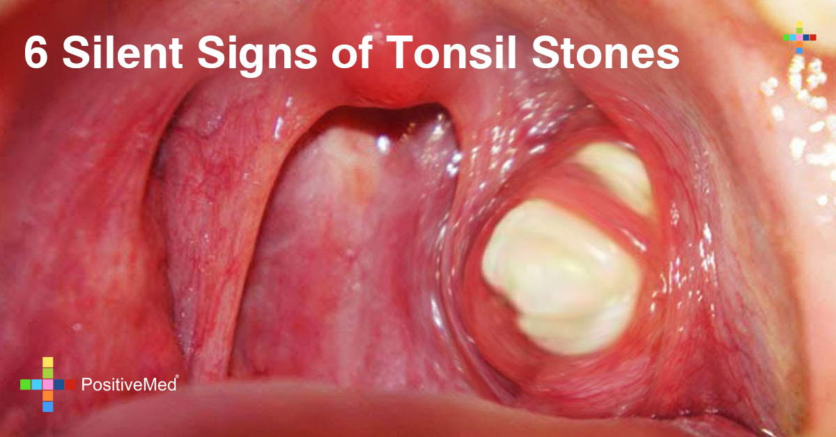 Tonsil Stones Symptoms