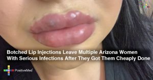 Botched Lip Injections Leave Multiple Arizona Women With Serious Infections After They Got Them Cheaply Done