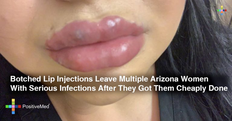 Botched Lip Filler Leave Multiple Arizona Women With Serious Infections After They Got Them Cheaply Done