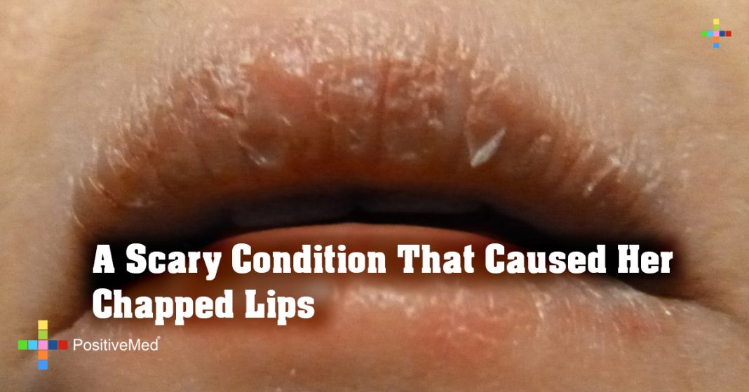 A Scary Condition That Caused Her Chapped Lips PositiveMed