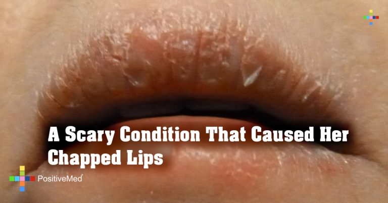 A Scary Condition That Caused Her Chapped Lips
