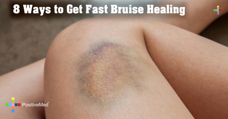8 Ways to Get Fast Bruise Healing 8 Ways to Get Fast Bruise Healing