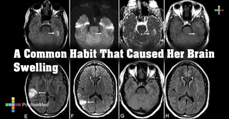 A Common Habit That Caused Her Brain Swelling A Common Habit That Caused Her Brain Swelling
