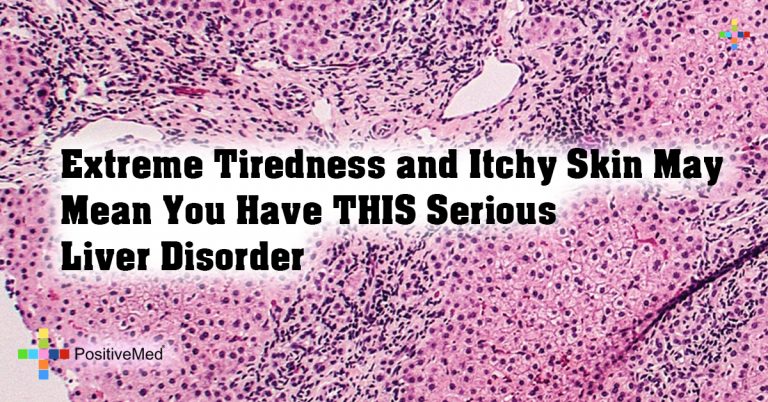 Extreme Tiredness and Itchy Skin May Mean You Have THIS Serious Liver Disorder