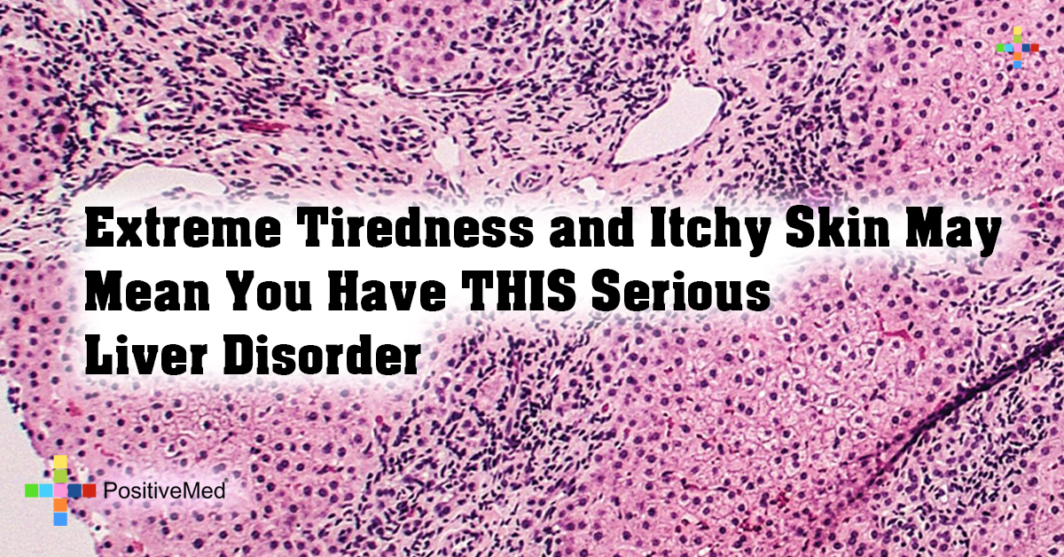 Extreme Tiredness and Itchy Skin May Mean You Have THIS Serious Liver Disorder