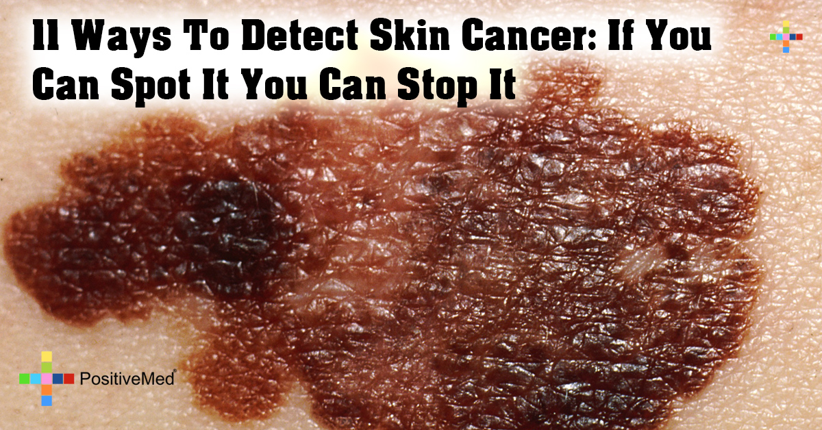 11 Ways To Detect Skin Cancer: If You Can Spot It You Can Stop It