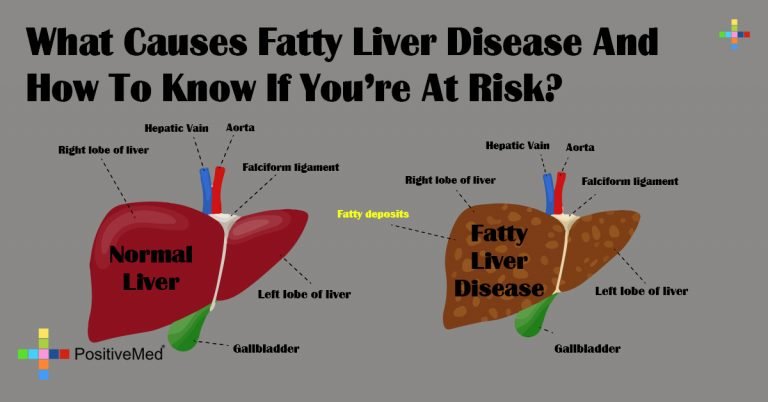 What Causes Fatty Liver Disease And How To Know If You’re At Risk?