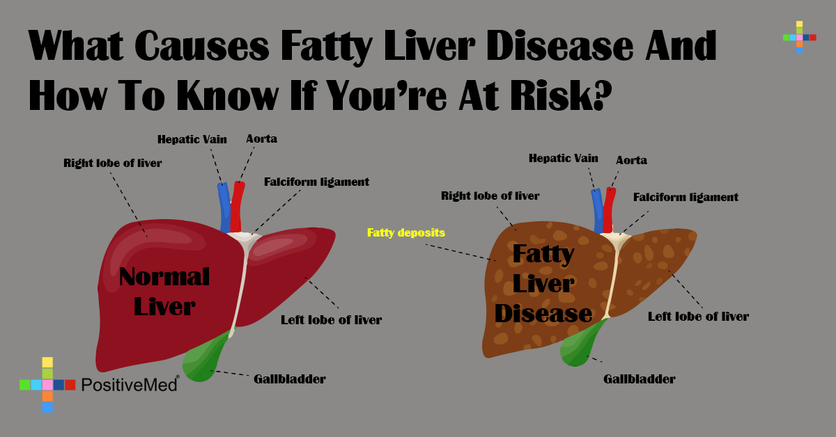 what causes fatty liver disease