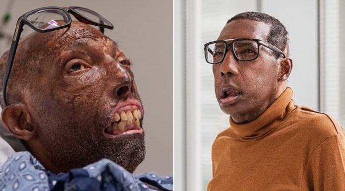 This Father Became the First Black Man to Get a Face Transplant