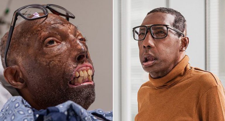 This Father Became the First Black Man to Get a Face Transplant This Father Became the First Black Man to Get a Face Transplant