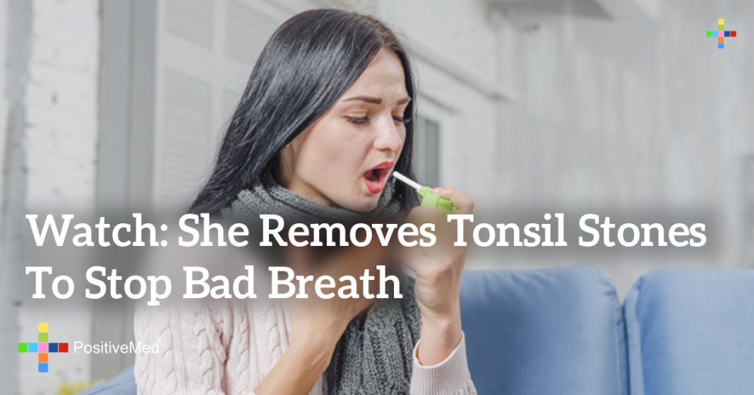 Watch She Removes Tonsil Stones to Stop Bad Breath PositiveMed