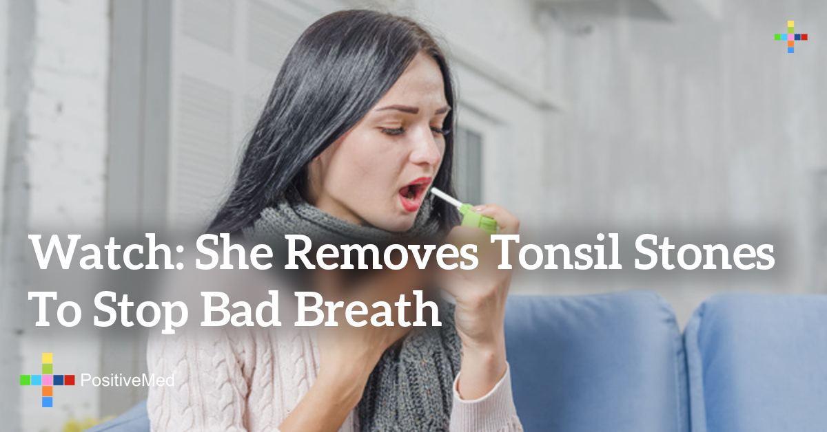 Watch She Removes Tonsil Stones to Stop Bad Breath PositiveMed