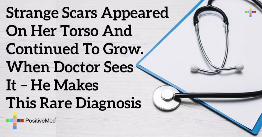 Strange Scars Appeared on Her Torso and Continued to Grow. When Doctor Sees It – He Makes This Rare Diagnosis