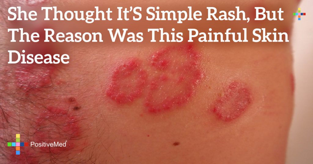 She Thought It’s Simple Rash, But the Reason Was THIS Painful Skin Disease