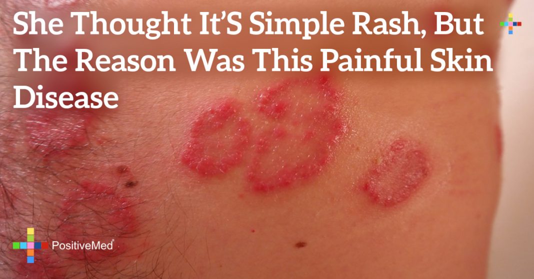 She Thought It's Simple Rash, But the Reason Was THIS Painful Skin