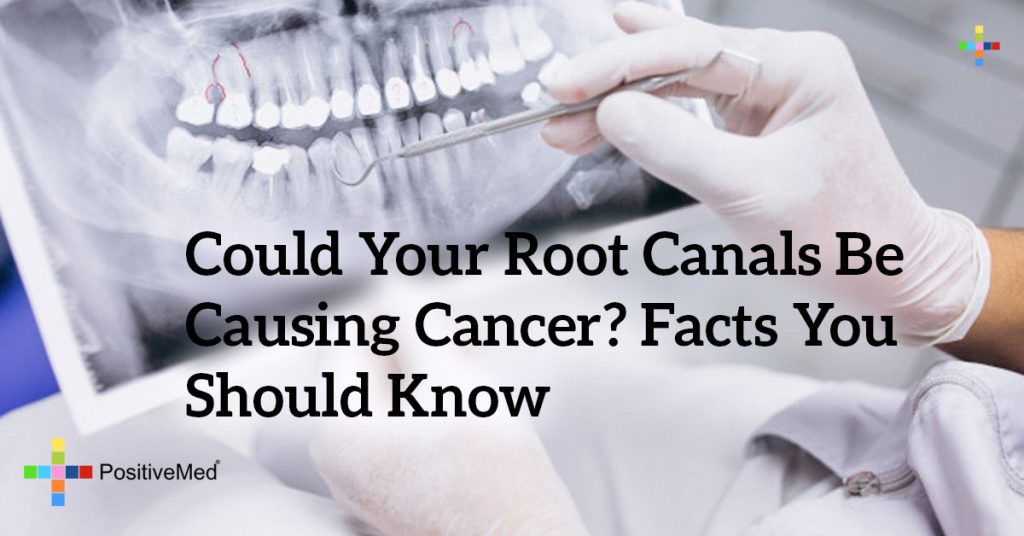 Could Your Root Canals Be Causing Cancer? Facts You Should Know
