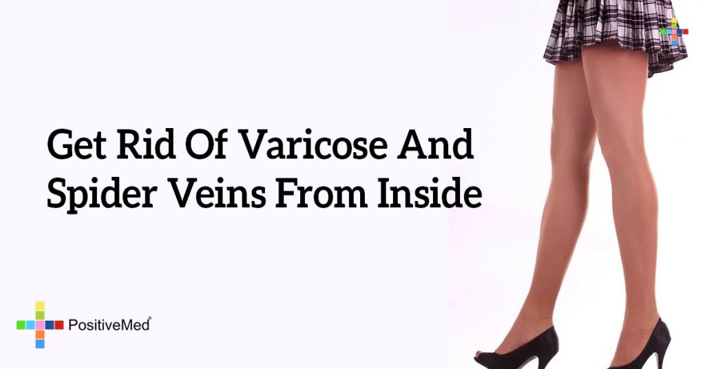 Get Rid of Varicose and Spider Veins From Inside