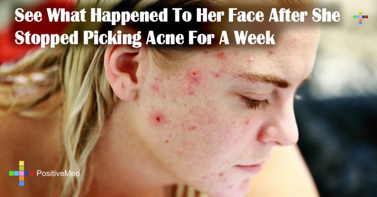 See What Happened To Her Face After She Stopped Picking Acne For A Week