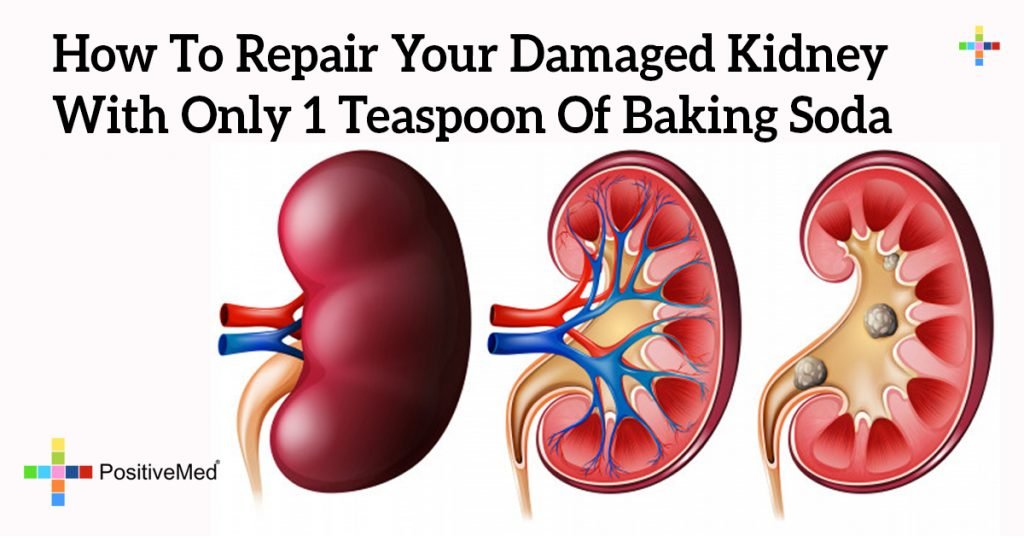 How To Repair Your Damaged Kidney With Only 1 Teaspoon Of Baking Soda