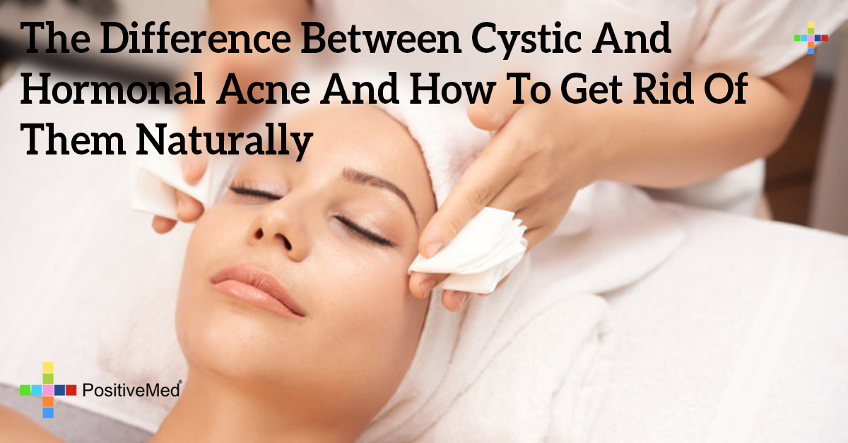 Hormonal Acne Cysts
