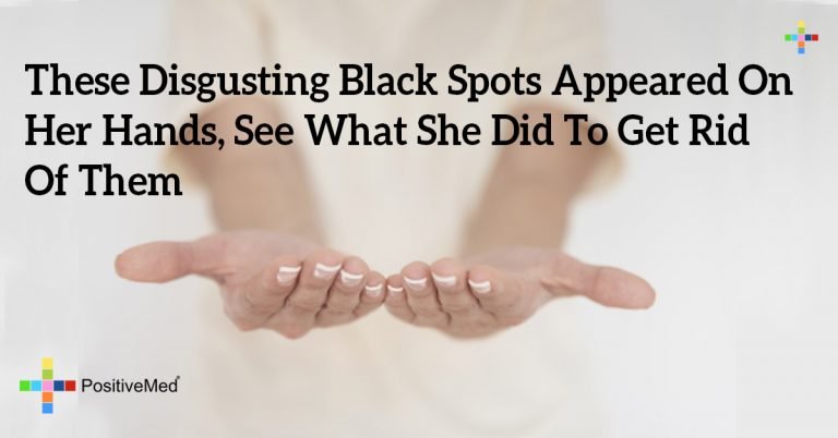 These Disgusting Black Spots Appeared On Her Hands, See What She Did To Get Rid Of Them