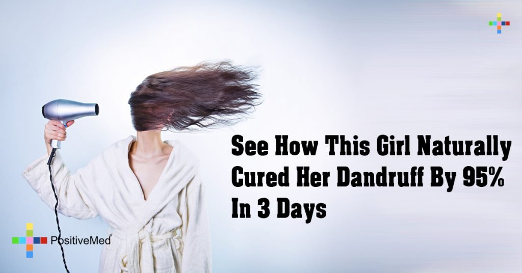 See How This Girl Naturally Cured Her Dandruff By 95% In 3 Days