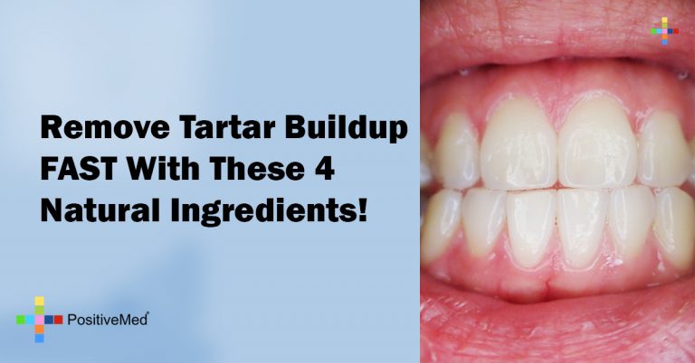 Remove Tartar Buildup FAST With These 4 Natural Ingredients!