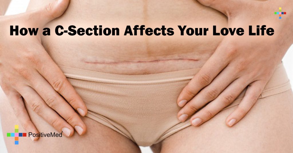 How a C-Section Affects Your Love Life