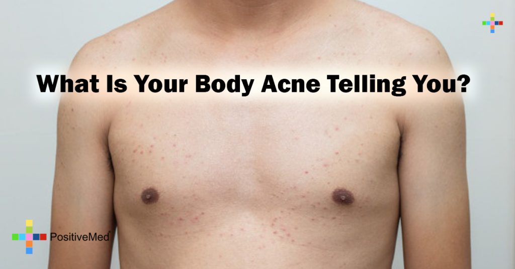 What Is Your Body Acne Telling You?