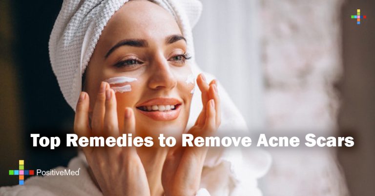 Top Remedies to Remove Acne Scars