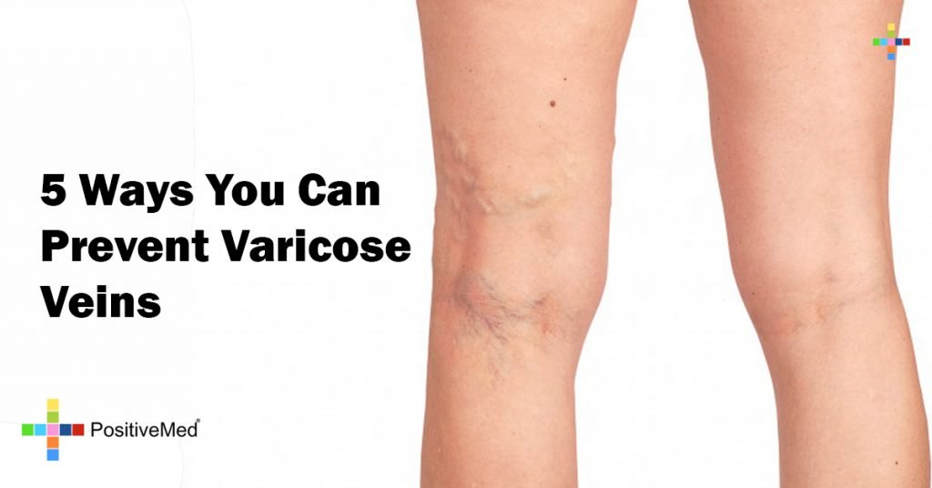 5 Ways You Can Prevent Varicose Veins